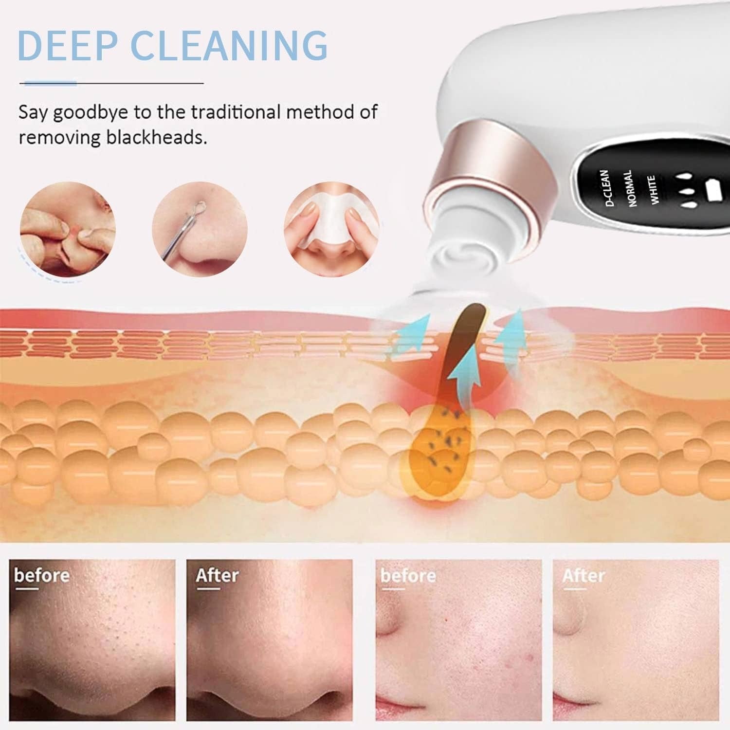 blackhead removal device for deep cleaning skin with before and after effects shown.